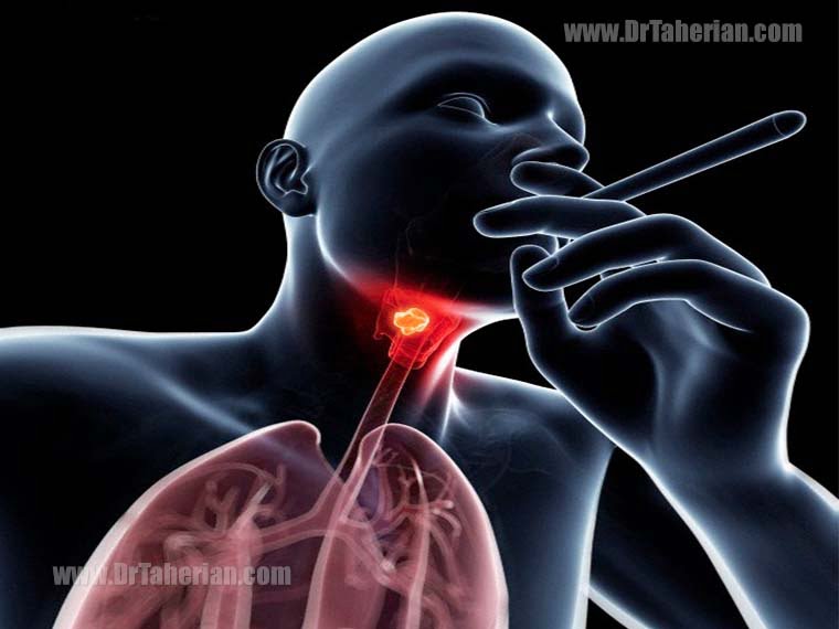 Throat Cancer Laryngeal Cancer Symptoms Causes Treatment 2892