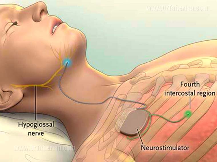 treatment of sleep apnea