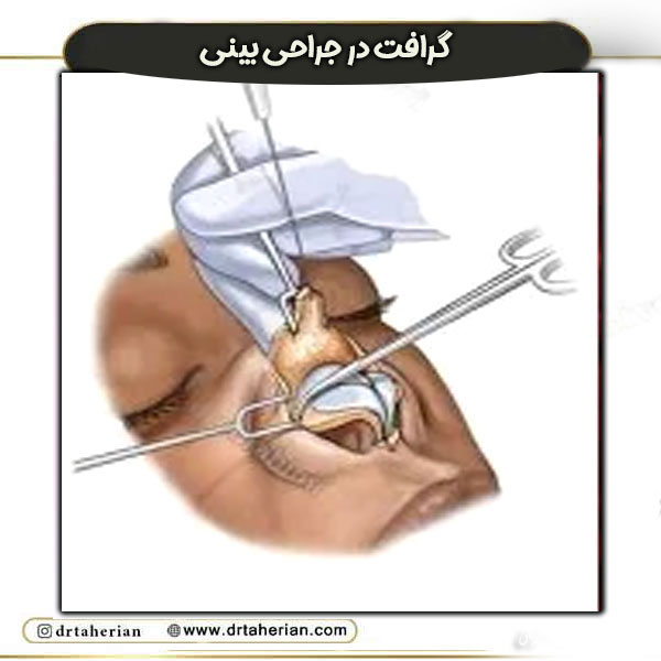 گرافت در جراحی بینی